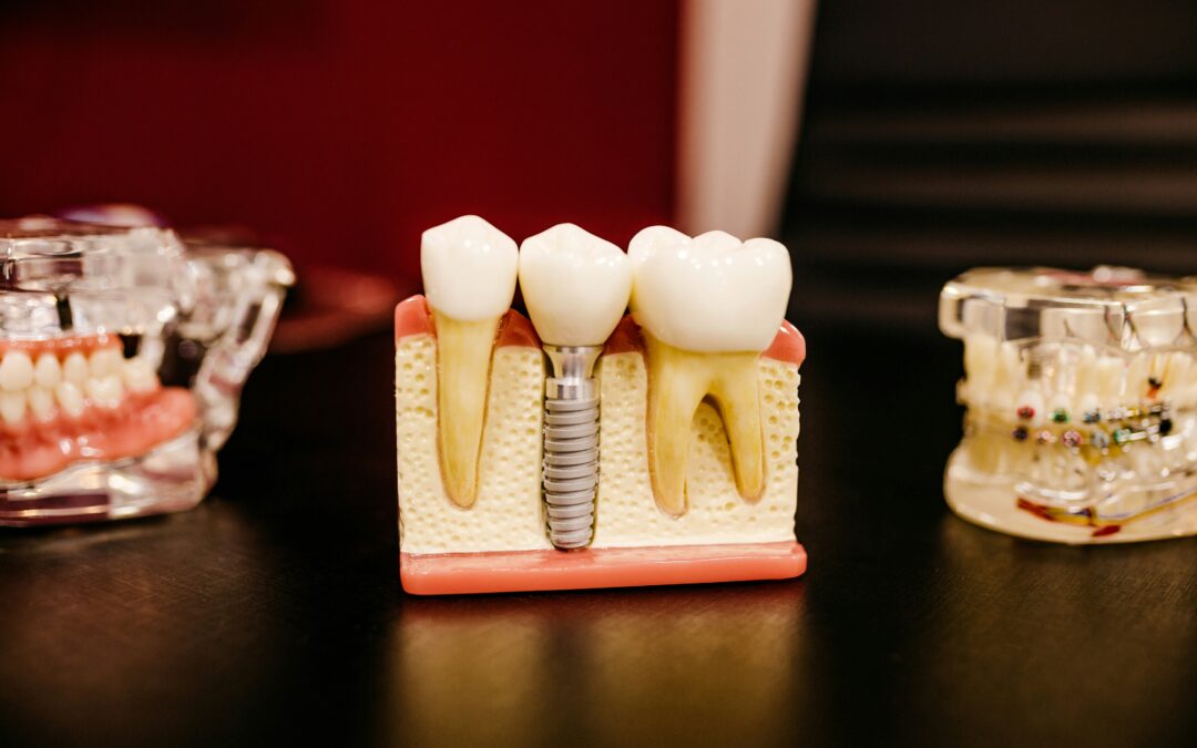 E vai-se um (outro) dente